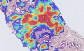 Digitized breast biopsy slide analyzed by the AI tool