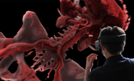 AVATAR MEDICAL's technology used to visualize an aortic dissection 